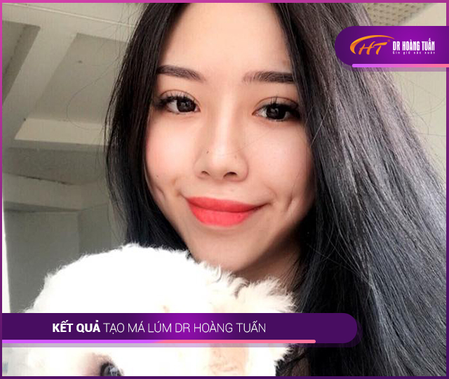 Kết quả tạo má lúm Thẩm mỹ Hoàng Tuấn